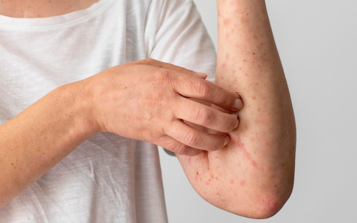 В ВКО 13 человек заболели корью